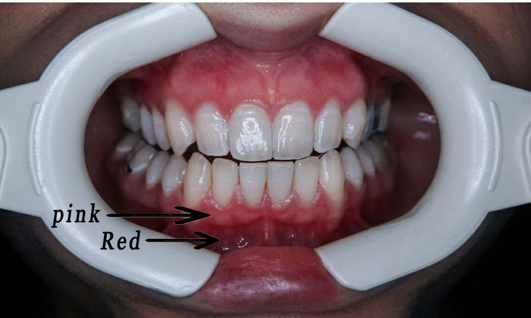 pink and red oral color